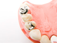 気になる銀歯を白くする審美歯科