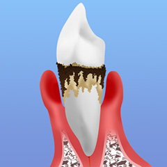 歯を失う怖い病気「歯周病」
