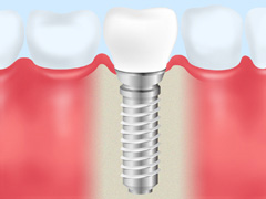 抜歯即時インプラント