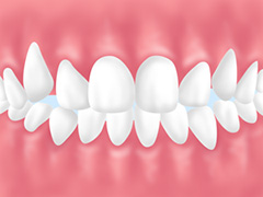 Trouble3 歯並び・咬み合わせの乱れ